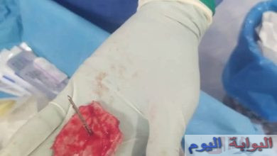 إنجاز طبي نادر بجامعة الفيوم: استخراج مسمار من جمجمة طفل دون إصابة المخ