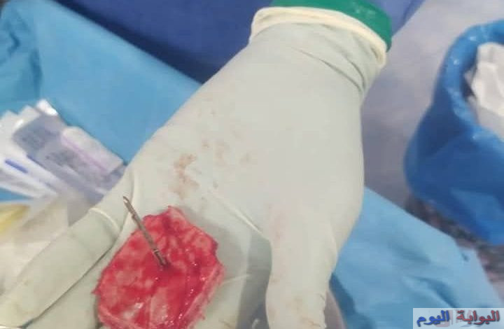 إنجاز طبي نادر بجامعة الفيوم: استخراج مسمار من جمجمة طفل دون إصابة المخ